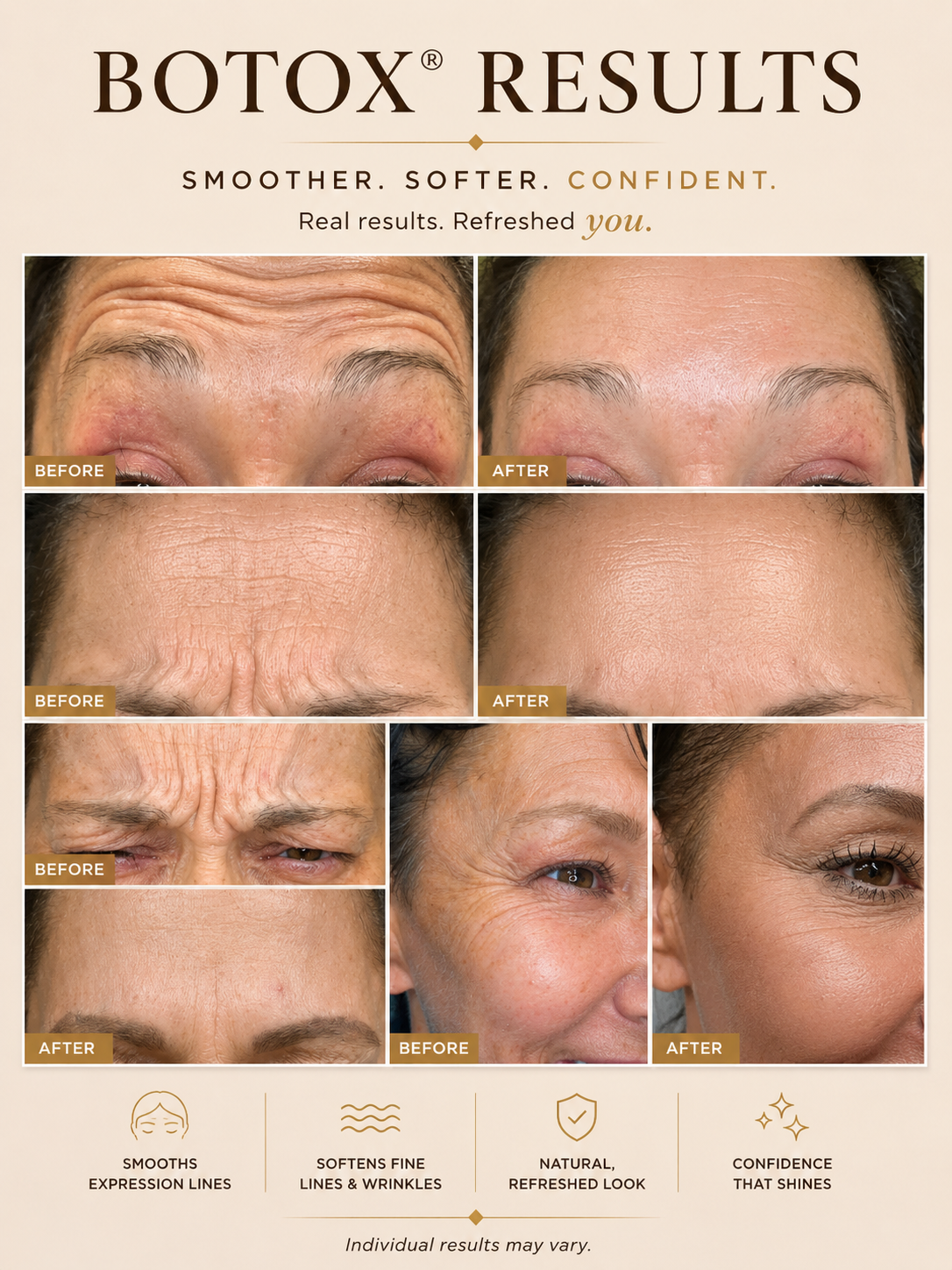 Botox results - before and after collage showing smoothed expression lines and refreshed appearance