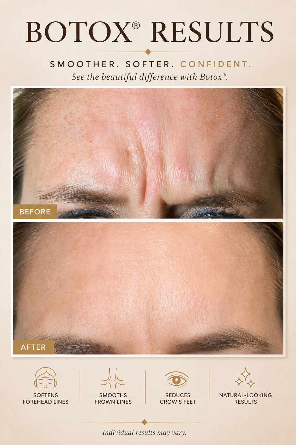 Botox results - before and after showing softened forehead lines and reduced crow's feet