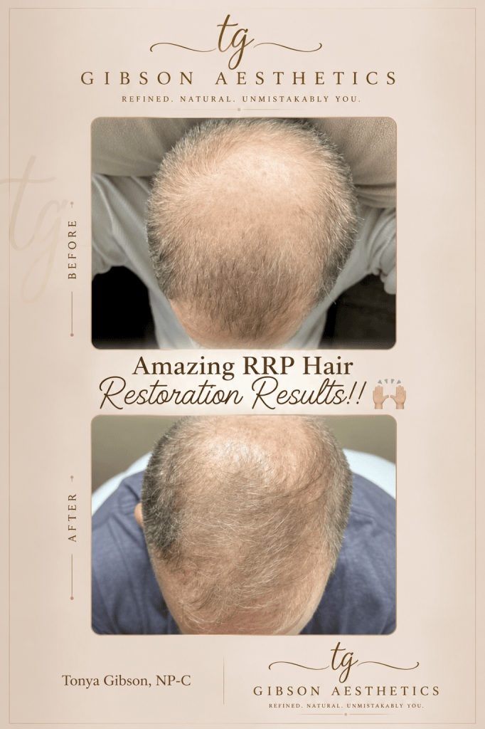 Amazing RRP Hair Restoration Results before and after