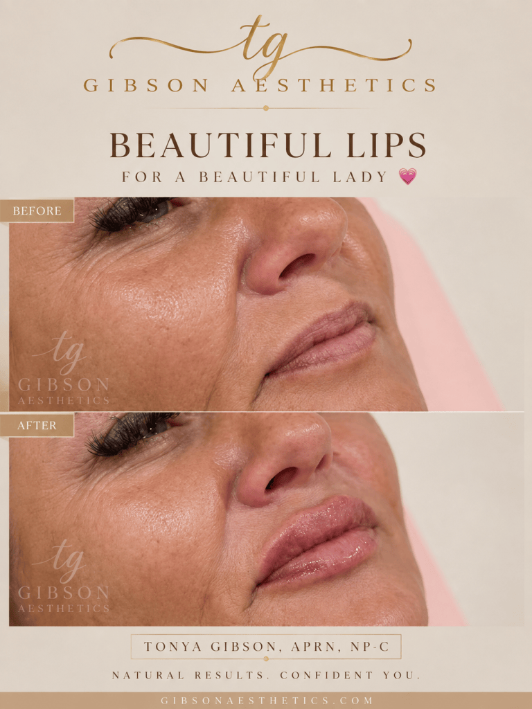 Beautiful lips for a beautiful lady - before and after