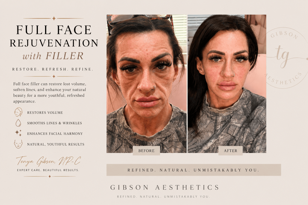 Full face rejuvenation with filler before and after