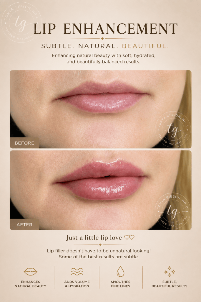Lip filler before and after - soft subtle beautiful results