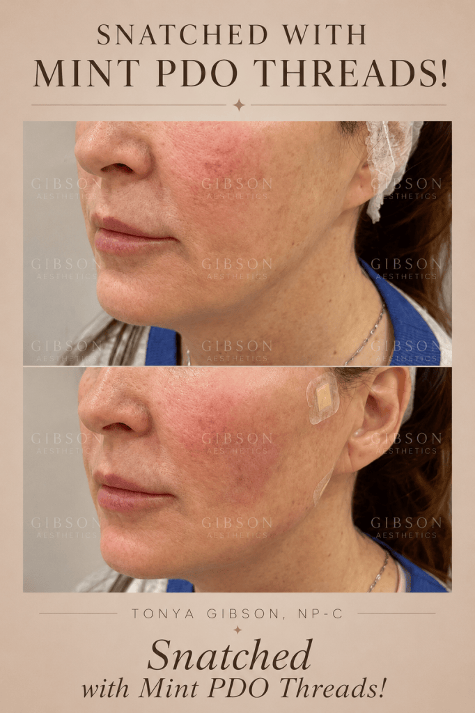 Snatched with Mint PDO Threads before and after