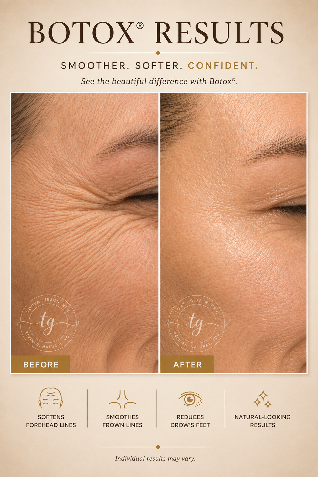 Botox results - before and after showing reduced crow's feet and forehead lines