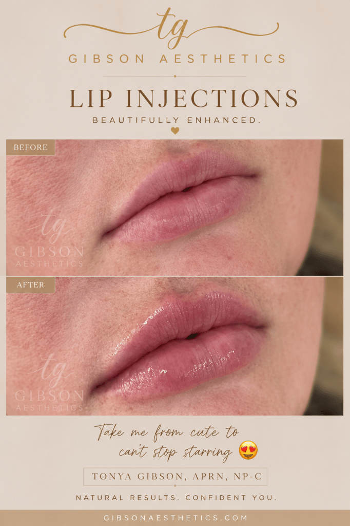 Lip injections - beautifully enhanced before and after