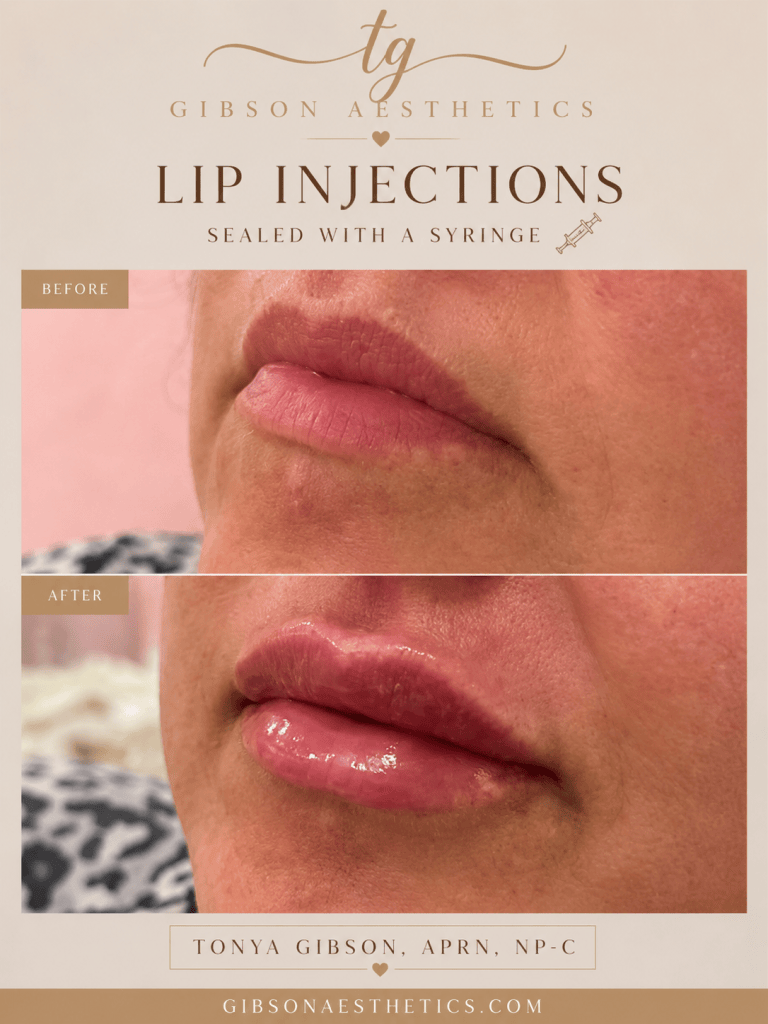 Lip injections before and after - sealed with a syringe