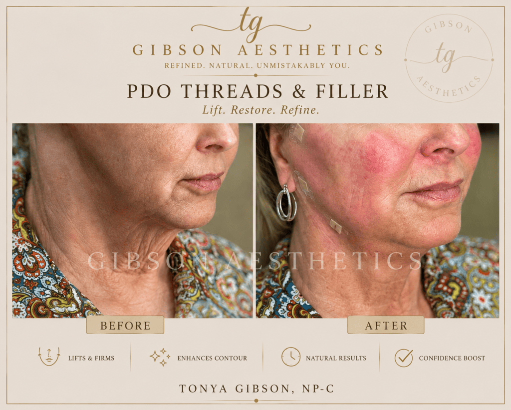 PDO threads and filler before and after - lifts and firms