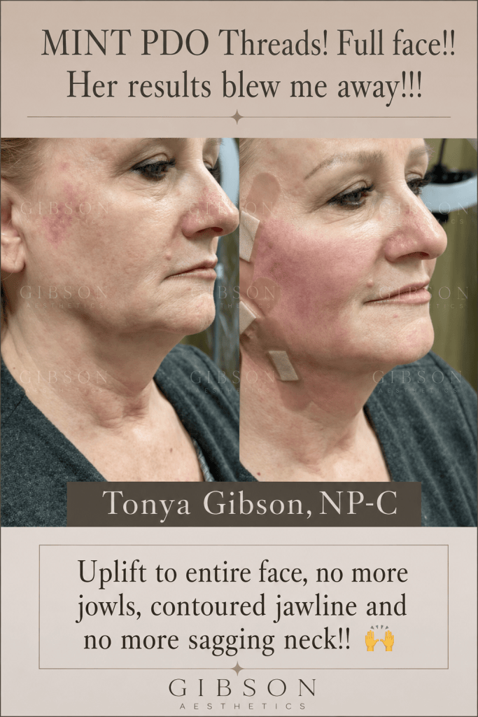 MINT PDO Threads full face snatched before and after
