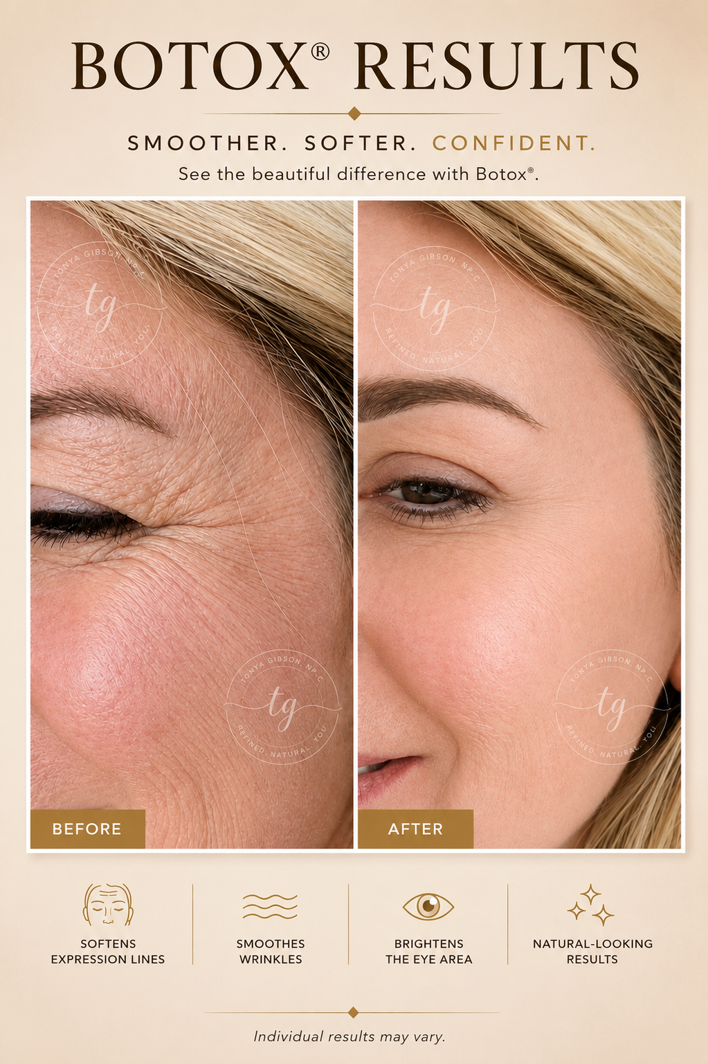 Botox results - before and after showing softened expression lines and brightened eye area