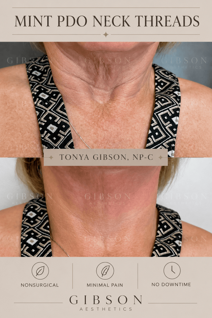 Mint PDO Neck Threads nonsurgical minimal pain no downtime