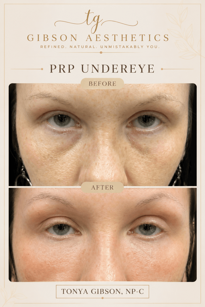 PRP Undereye before and after