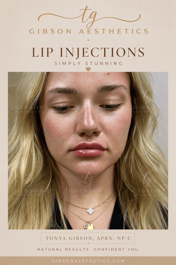 Lip injections - simply stunning natural results