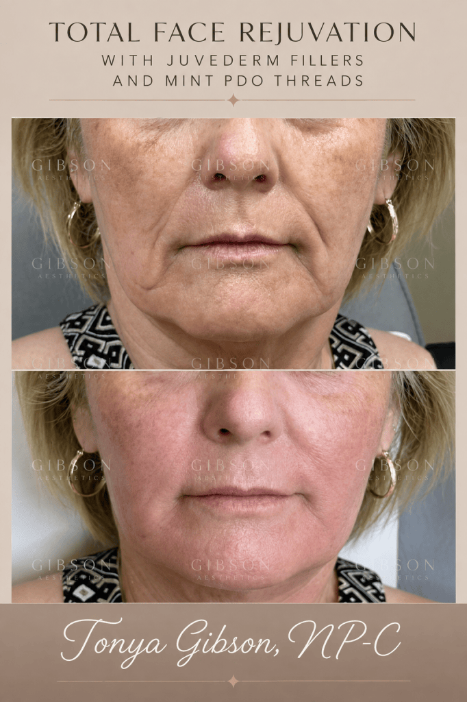 Total face rejuvenation with Juvederm fillers and Mint PDO Threads