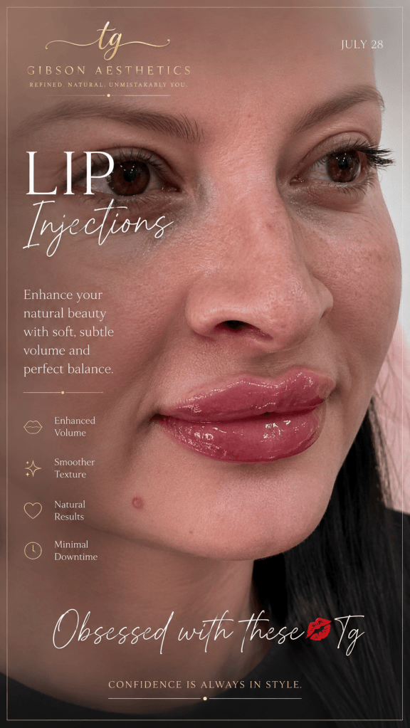 Lip injections result - beautifully enhanced lips
