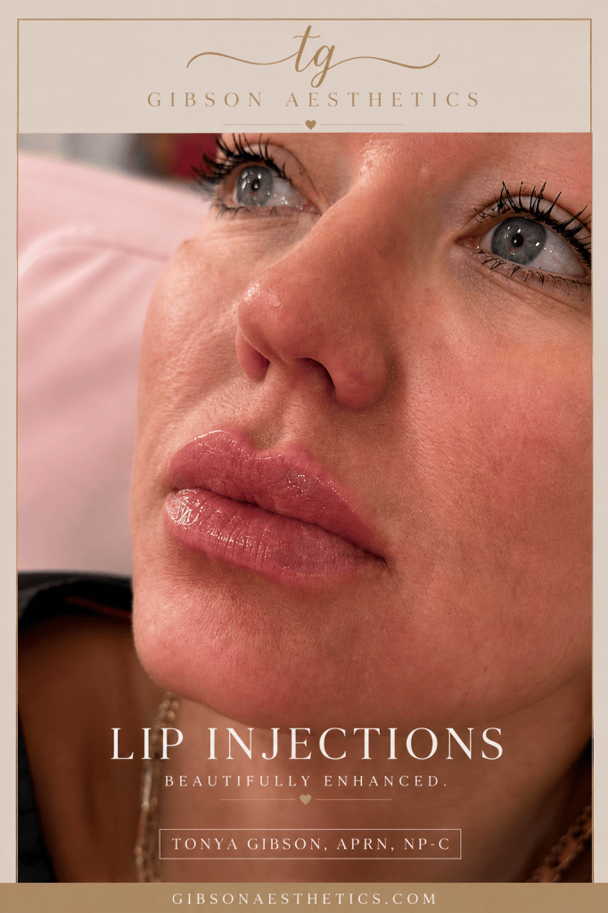 Lip injections - beautifully enhanced before and after