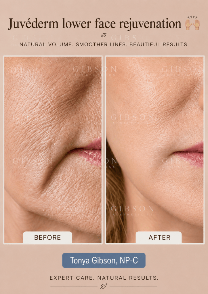 Juvederm lower face rejuvenation before and after