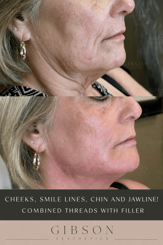 Cheeks smile lines chin and jawline combined threads with filler