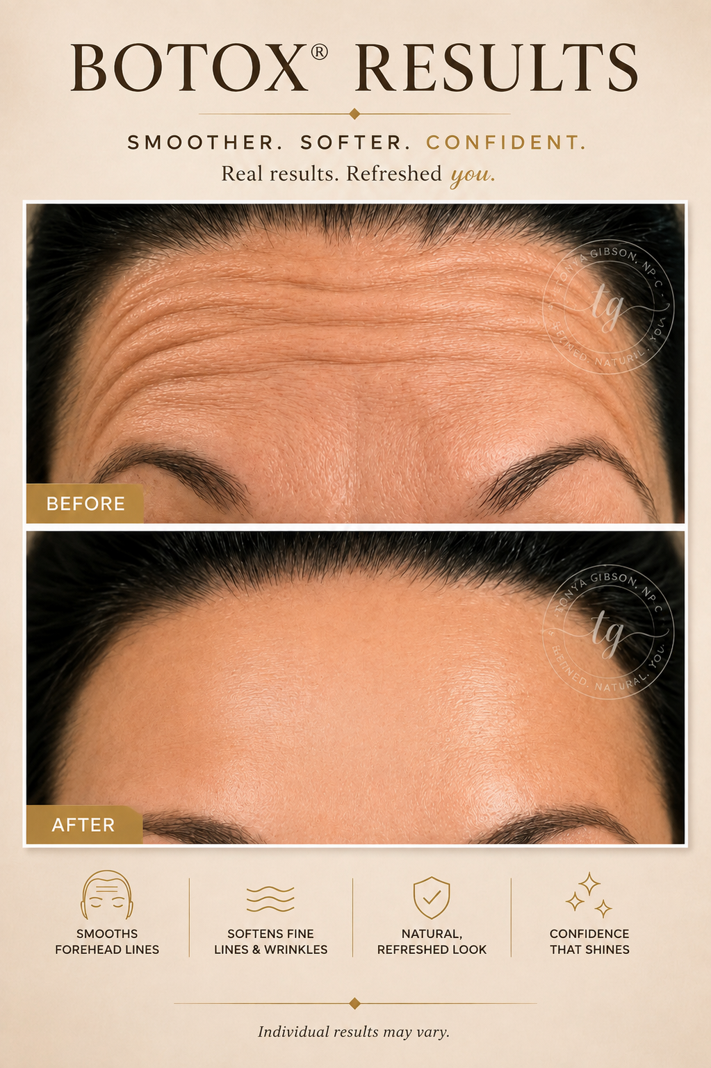 Botox results - before and after showing smoothed forehead lines