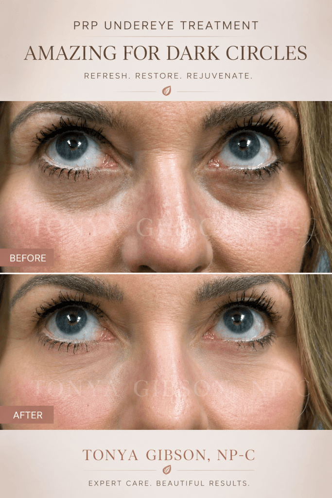 PRP Undereye Treatment - amazing for dark circles before and after