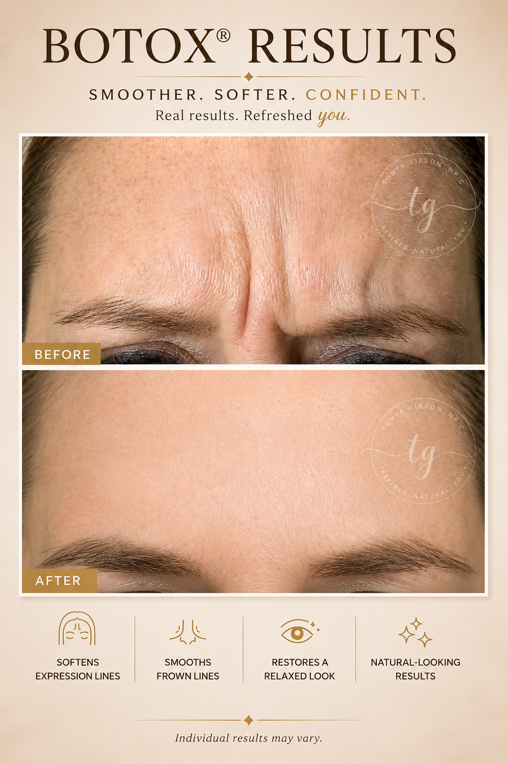 Botox results - before and after showing smoother expression lines