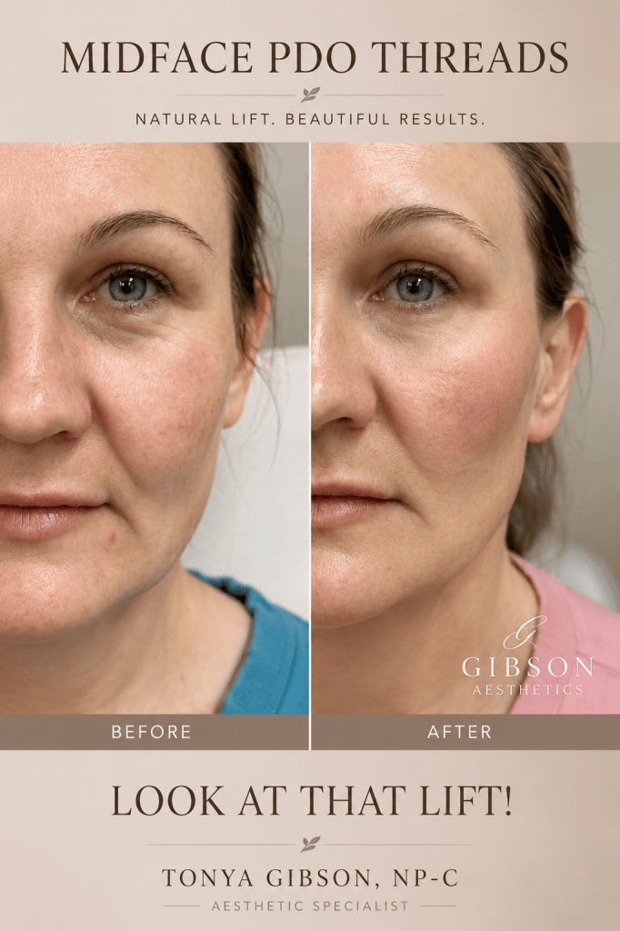Midface PDO Threads natural lift beautiful results